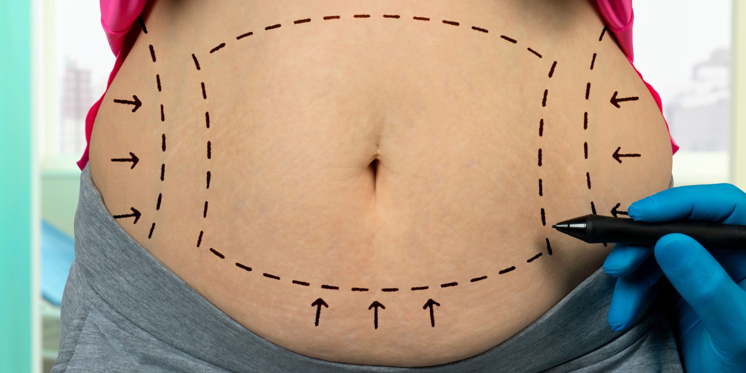 Abdominoplasty: Tummy Tuck Surgery