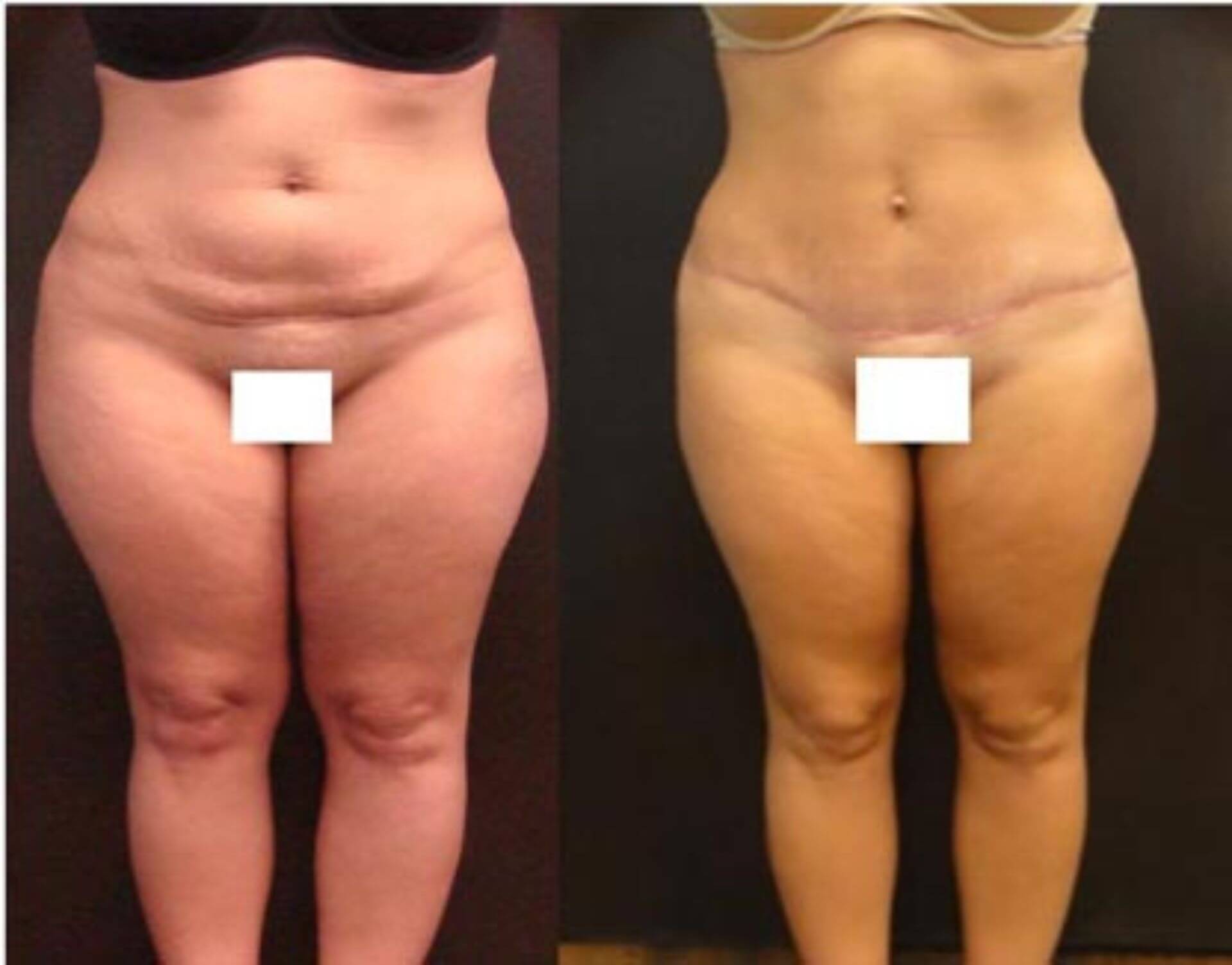 dr-penelope-treece-metairie-plastic-surgeon-before-after-abdominoplasty-1