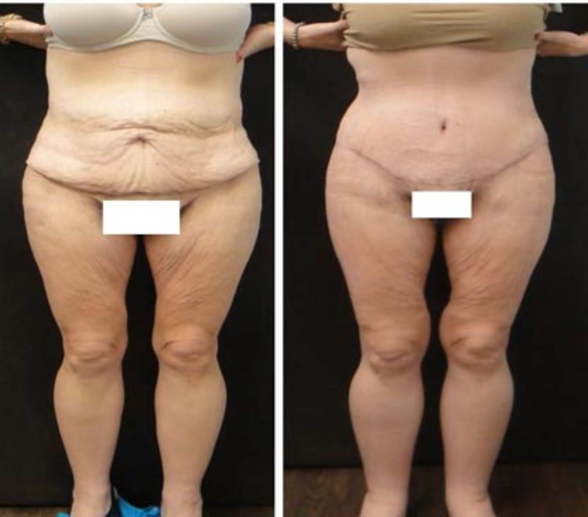 dr-penelope-treece-metairie-plastic-surgeon-before-after-abdominoplasty-6