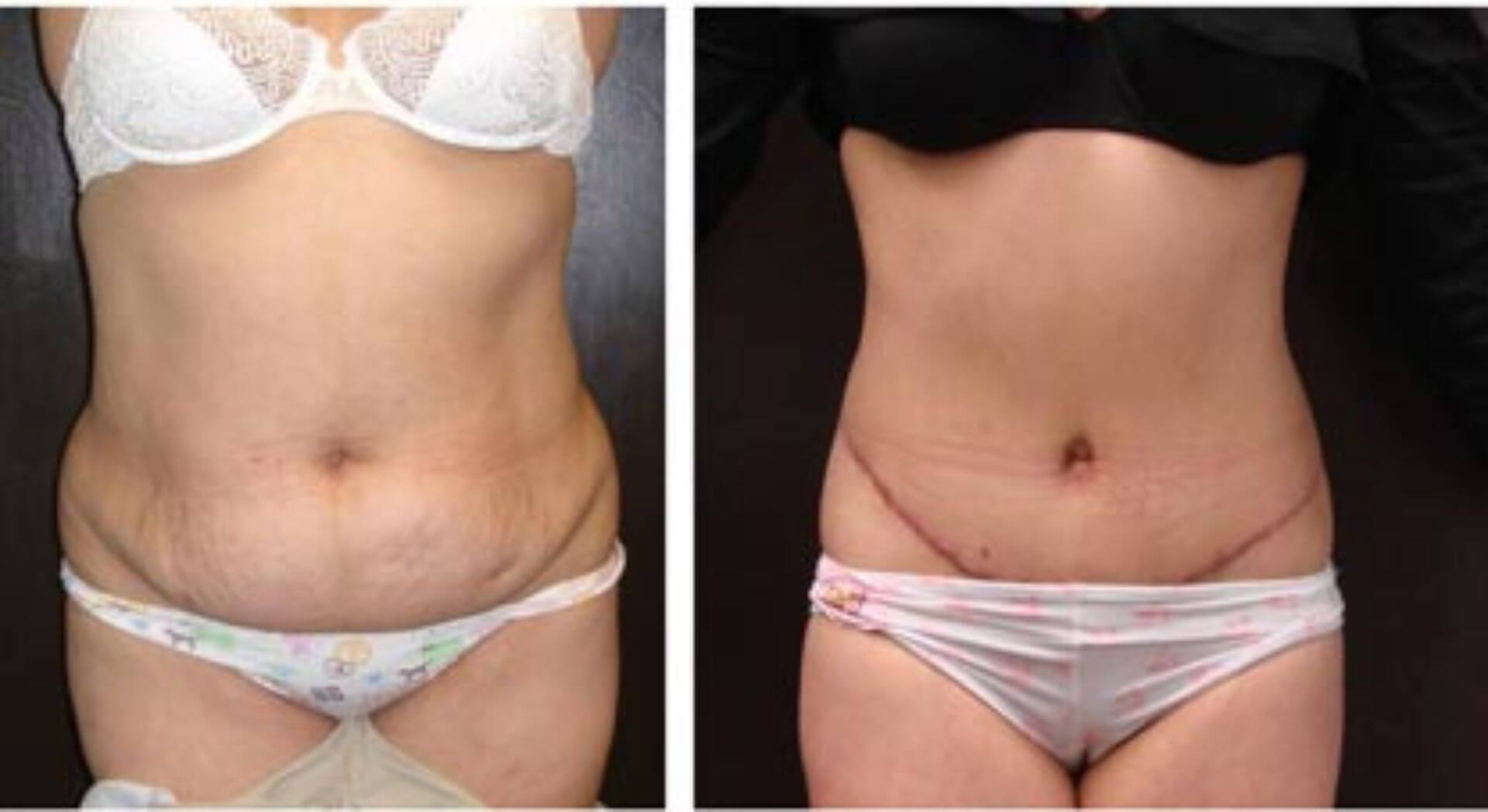 dr-penelope-treece-metairie-plastic-surgeon-before-after-abdominoplasty-7