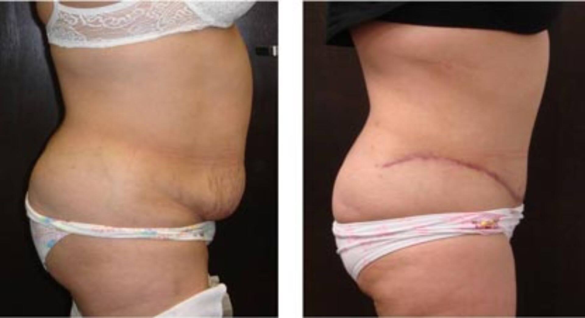 dr-penelope-treece-metairie-plastic-surgeon-before-after-abdominoplasty-9 (1)