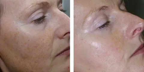 Laser Genesis Treatment for Skin Rejuvenation