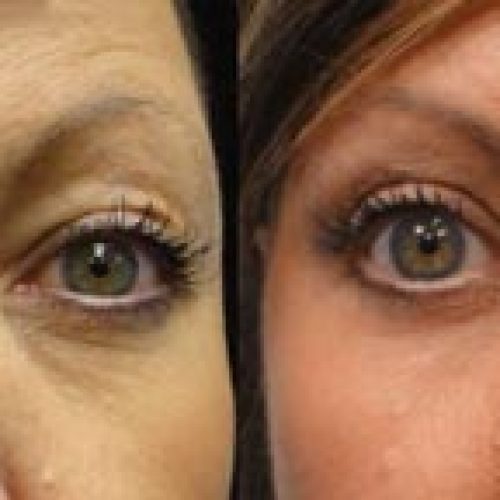 dr-penelope-treece-metairie-plastic-surgeon-before-after-BLEPHAROPLASTY-2