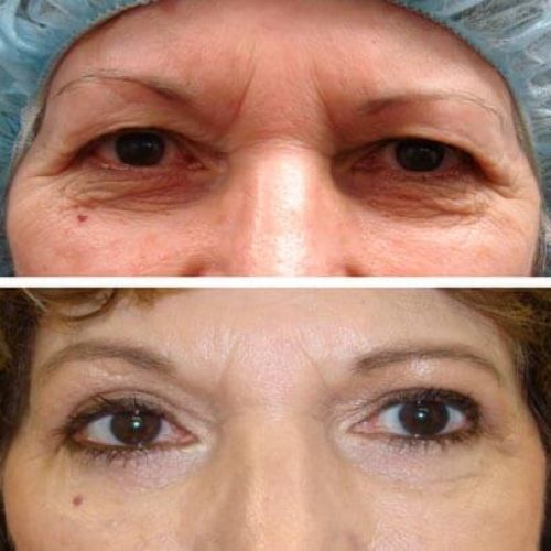 dr-penelope-treece-metairie-plastic-surgeon-before-after-BLEPHAROPLASTY-5