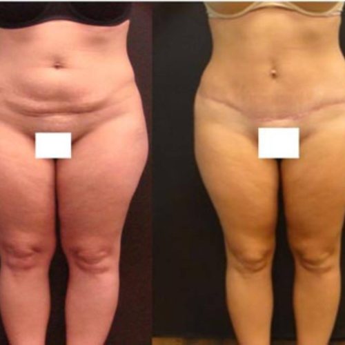 dr-penelope-treece-metairie-plastic-surgeon-before-after-abdominoplasty-1