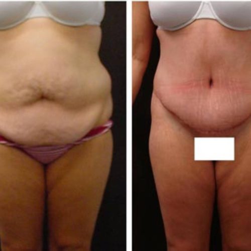 dr-penelope-treece-metairie-plastic-surgeon-before-after-abdominoplasty-3
