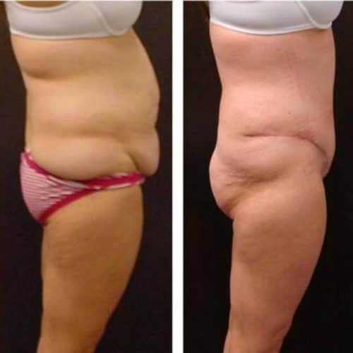 dr-penelope-treece-metairie-plastic-surgeon-before-after-abdominoplasty-4