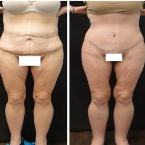 dr-penelope-treece-metairie-plastic-surgeon-before-after-abdominoplasty-6