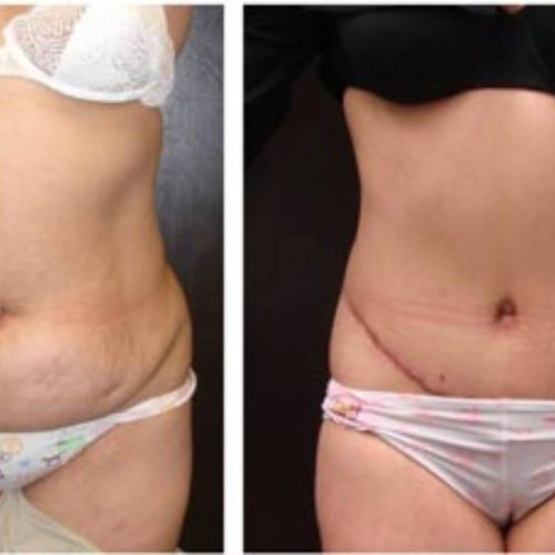 dr-penelope-treece-metairie-plastic-surgeon-before-after-abdominoplasty-7