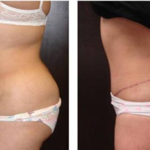 dr-penelope-treece-metairie-plastic-surgeon-before-after-abdominoplasty-8