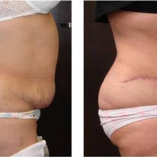 dr-penelope-treece-metairie-plastic-surgeon-before-after-abdominoplasty-9