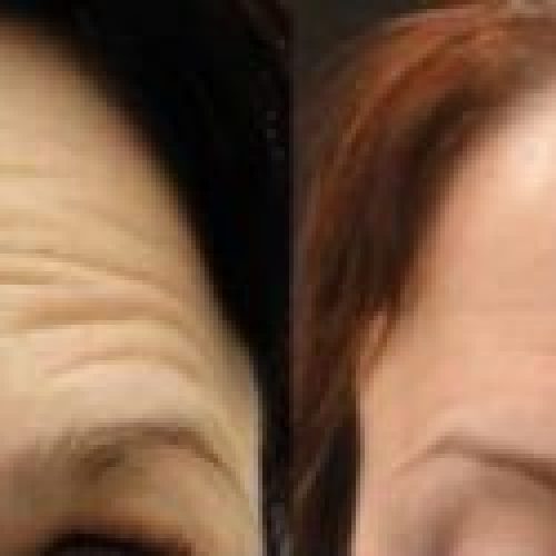 dr-penelope-treece-metairie-plastic-surgeon-before-after-botox-4-270x125-1