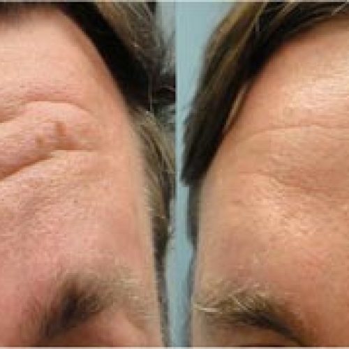 dr-penelope-treece-metairie-plastic-surgeon-before-after-botox-8