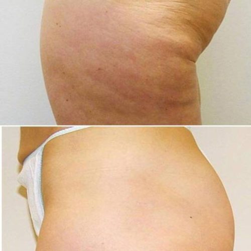 dr-penelope-treece-metairie-plastic-surgeon-before-after-coolsculpting-1
