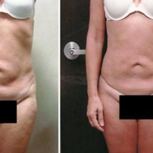 dr-penelope-treece-metairie-plastic-surgeon-before-after-coolsculpting-2