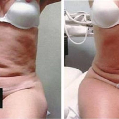 dr-penelope-treece-metairie-plastic-surgeon-before-after-coolsculpting-3-1