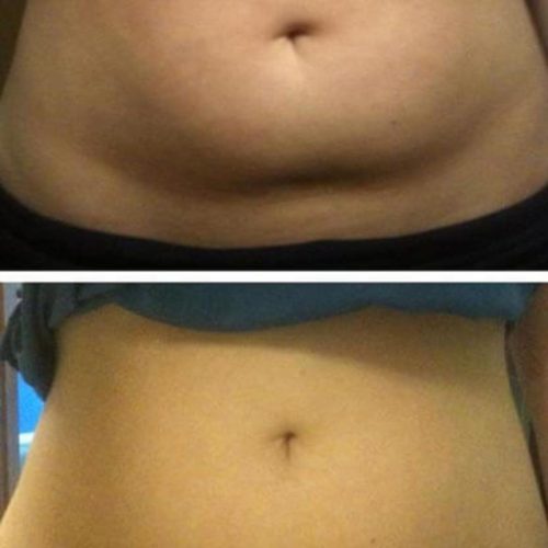 dr-penelope-treece-metairie-plastic-surgeon-before-after-coolsculpting-4-1
