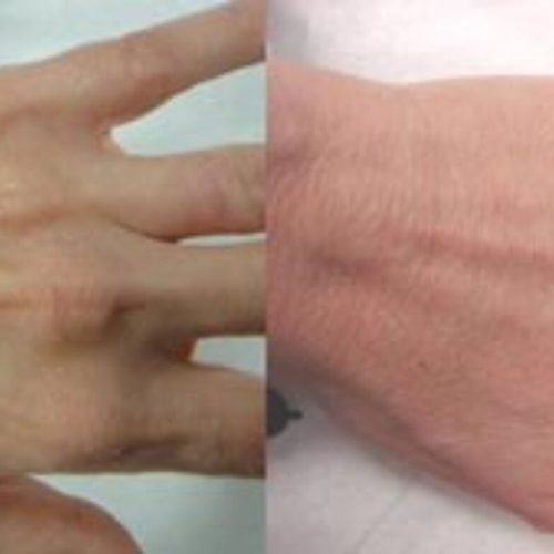 dr-penelope-treece-metairie-plastic-surgeon-before-after-hand-rejuvenation-2