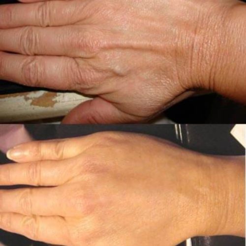 dr-penelope-treece-metairie-plastic-surgeon-before-after-hand-rejuvenation-3