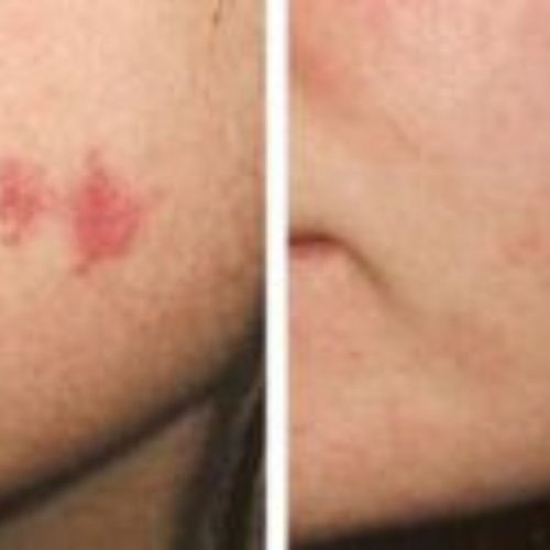 dr-penelope-treece-metairie-plastic-surgeon-before-after-vein-therapy-2-1920x889-1