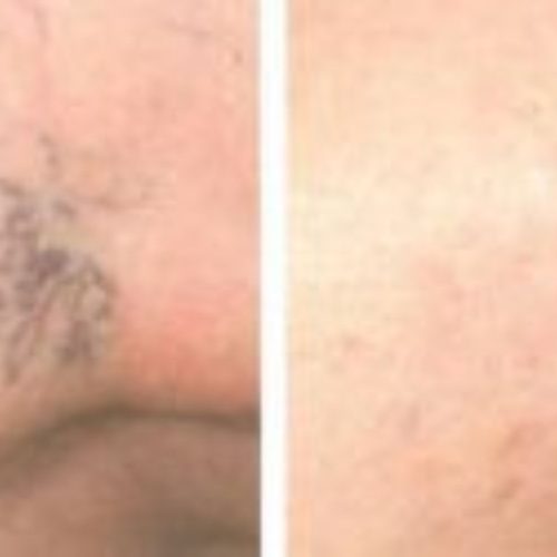 dr-penelope-treece-metairie-plastic-surgeon-before-after-vein-therapy-3-1920x889-1