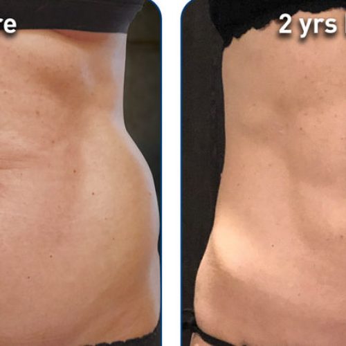 renuvion-before-after-abdominal-case-1-photos_front_72dpi-e1643054727540