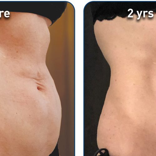 renuvion-before-after-abdominal-case-1-photos_right-side-300dpi-e1643054673186