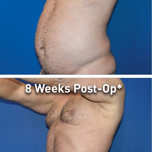 renuvion-before-after-abdominal-case-7_kohan_photos_300dpi-e1643054872508